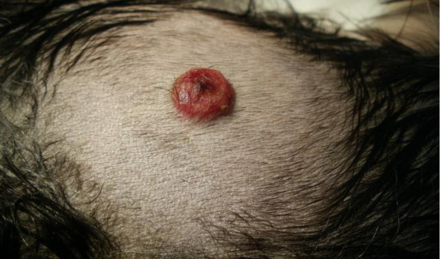 Histiocytome rouge et rond sur la peau rasée d'un chien